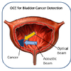 This invention uses OCT for elastography to achieve unprecedented analysis of small structures OCE For Bladder Cancer Detection