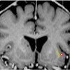 Claustrum Stimulation Site