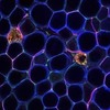 Insulin-Resistant Diabetes in Cells Inflammation from Insulin Resistance