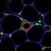 Diabetes Cells in the Body Cells Diseased with Diabetes
